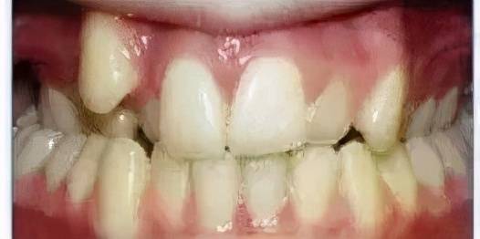 牙齿畸形，凸嘴该如何矫正？#雅悦齿科#