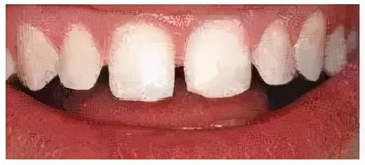 牙齿畸形，凸嘴该如何矫正？#雅悦齿科#