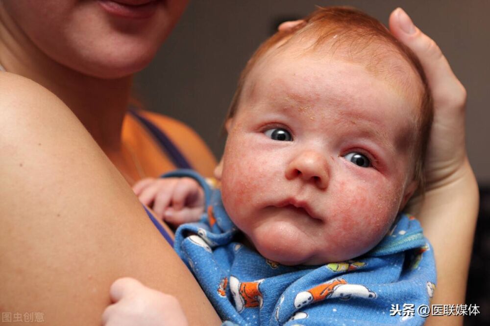 新生儿长湿疹怎么办？用这4招来搞定，不做“红宝宝”