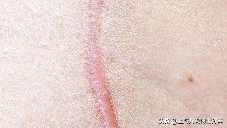 激光祛疤能去除什么样的疤痕，几次能做到没有痕迹呢？