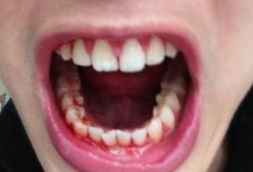 每天刷牙都会发现牙龈出血怎么办？牙龈出血是上火导致的吗？