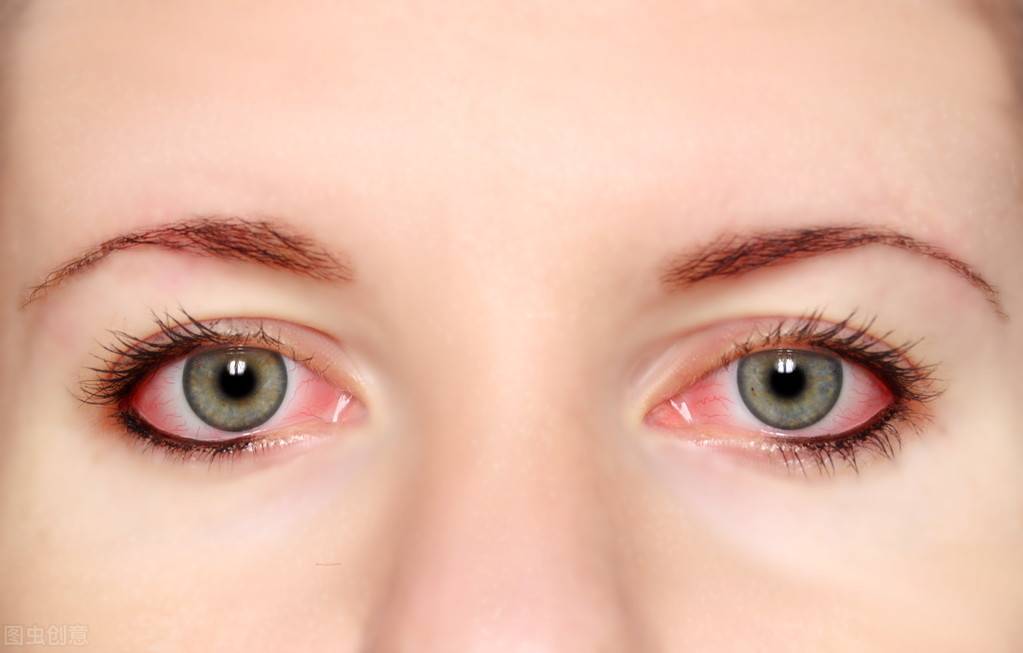 眼睛里总有红血丝？6个方法教你快速消除眼睛红血丝
