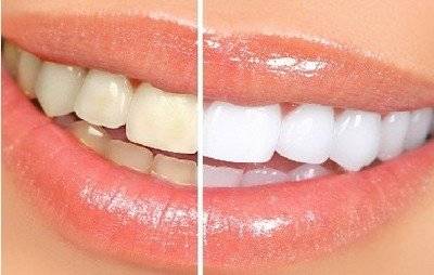 明星的牙齿为什么都那么白？其实大部分都做了贴面，牙医为你揭秘