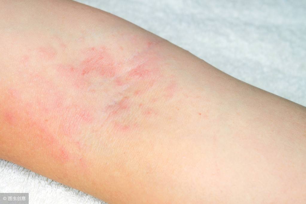 皮肤过敏，全身起红疹？这5个办法刚好“对症下药”