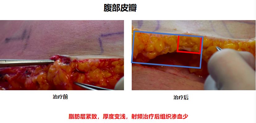 吸脂痛吗？价格大概多少？