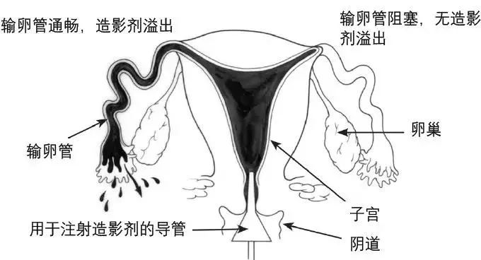 做输卵管造影疼吗？