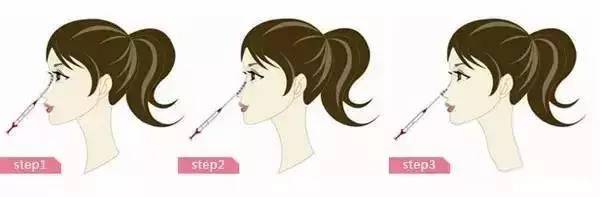 注射隆鼻效果如何？怎么进行的？