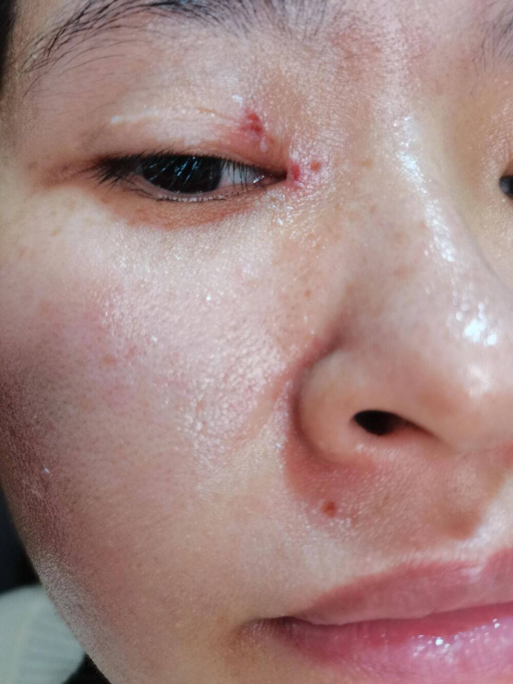 分享一下我在福州省立医院皮肤科点痣恢复过程