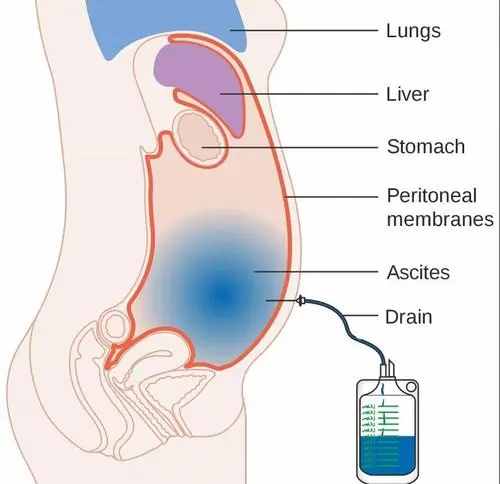治疗肝腹水有哪些好的办法？