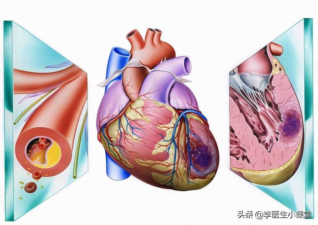 医生教你：突发心梗的急救方法，学会了关键时刻能救命