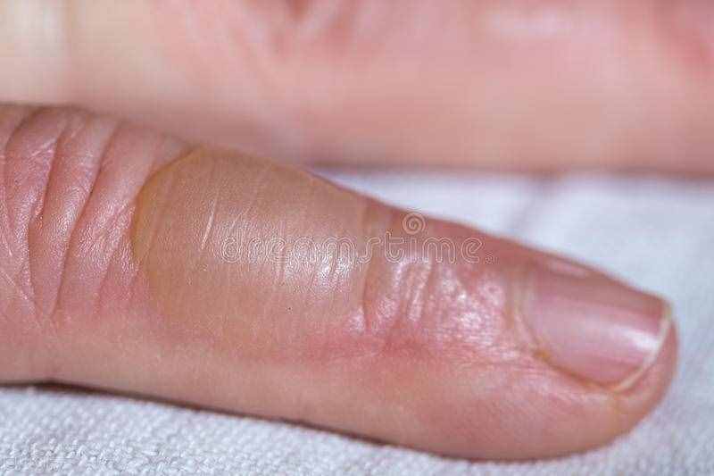 烧烫伤后如何及时处理，出现疤痕怎么办？