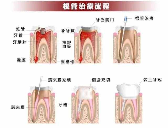 根管治疗原来这么贵，终于知道保护牙齿有多重要了