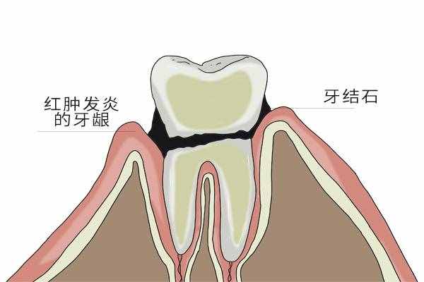 为什么医生建议每年洗牙一次？明明每天都刷牙，也需要洗牙吗？