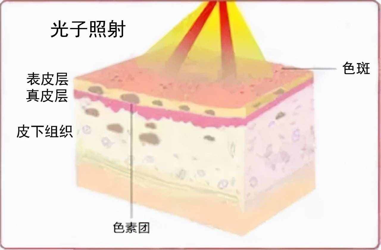 关于光子嫩肤的一切，看完都明白了