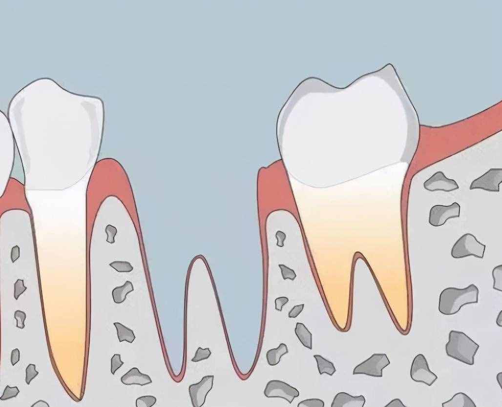 拔牙后最怕的是“牙洞”的恢复期！需要多久才能愈合？