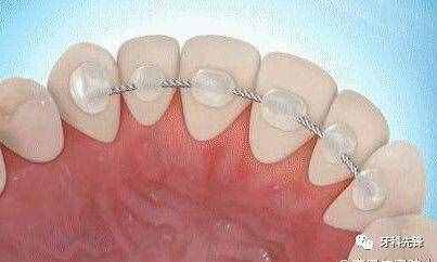 80%的牙齿矫正患者因为这个环节最终失败