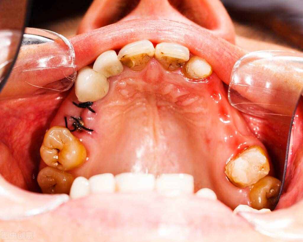 拔完牙不能吐口水？注意！拔牙后的护理比拔牙还重要 #雅悦齿科#