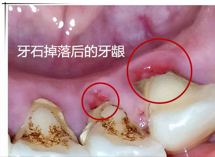 300元和2000元的洗牙费用如何区别和选择？看完告别小白