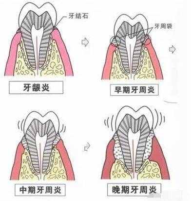 普通洗牙200，深度洗牙3000！深度洗牙是忽悠还是真的？