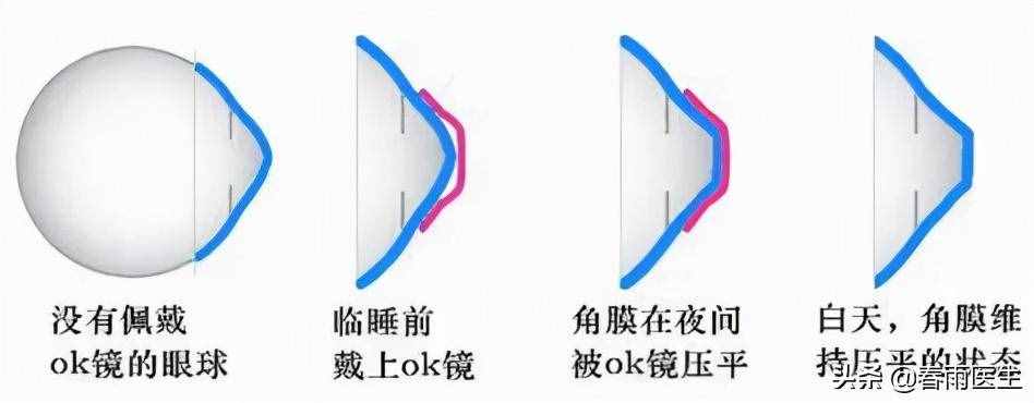 睡一觉就能逆转近视？OK镜真的这么OK吗