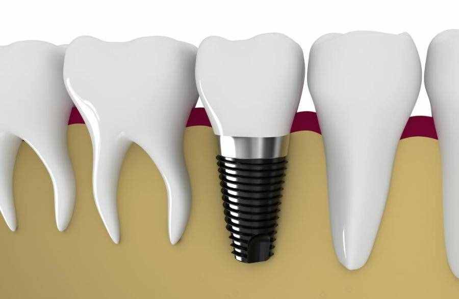 半岛叨叨丨种植牙动辄上万，一颗假牙成本才百元？