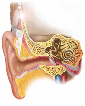 人工耳蜗为何值20万？丢失后需重新开颅植入？