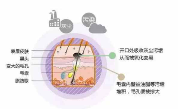 聊聊关于黑头的那些事，是不是也让你很困扰？