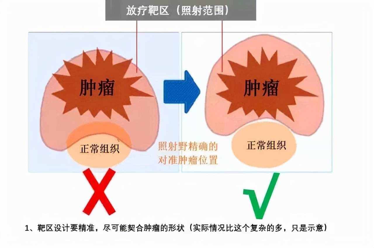 搞清楚放疗流程，明明白白地接受放疗