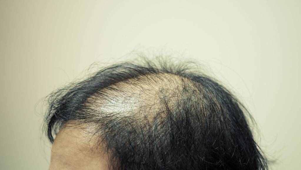 脱发掉发，可能是肝肾问题，这样做，滋养头皮，收获秀发