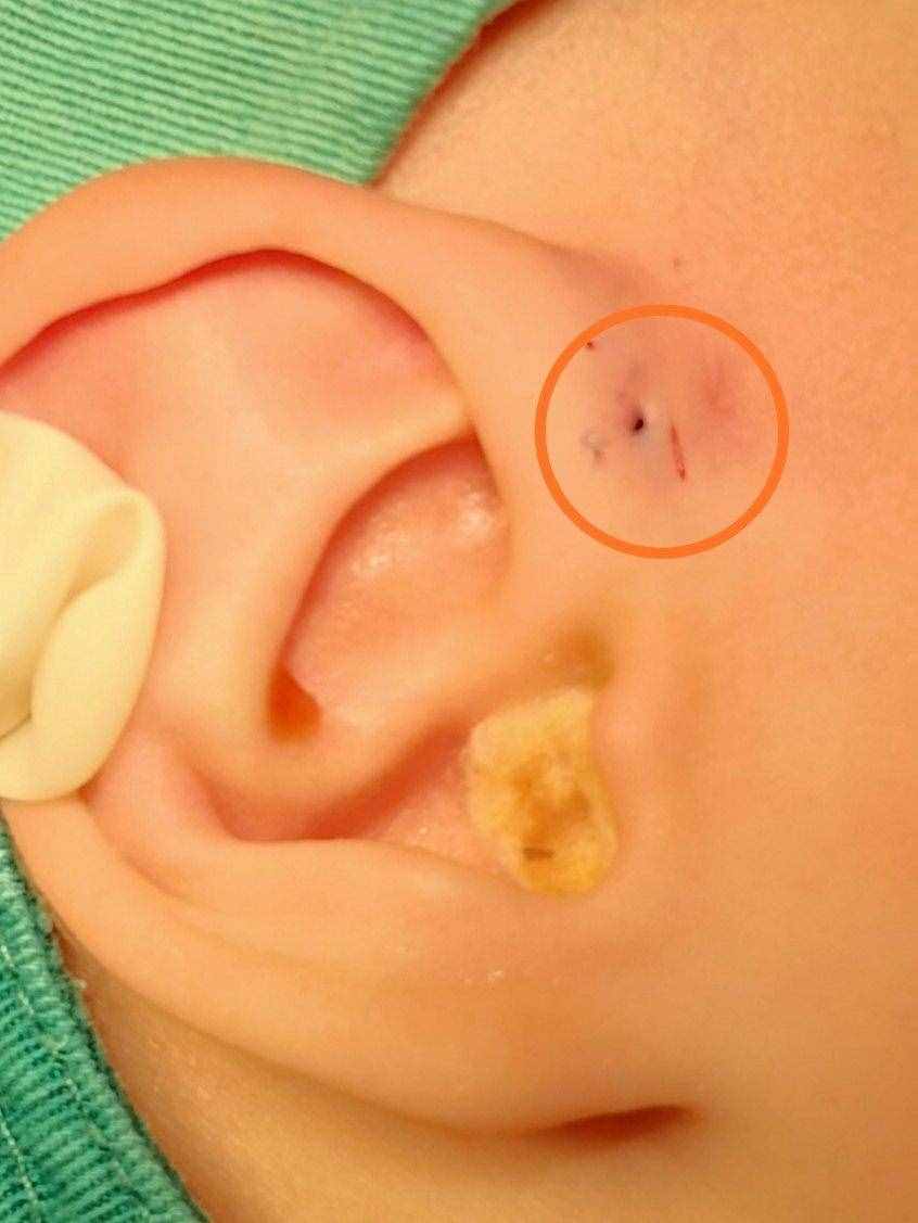 吕印菊医生：宝宝耳朵附近有个小孔是怎么回事