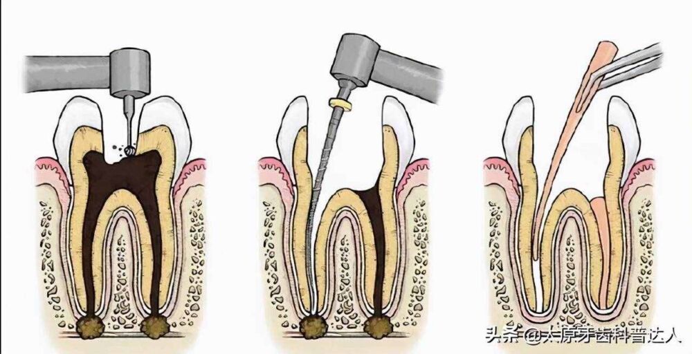 为什么根管治疗要分好多次？