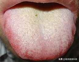 神了！舌苔的颜色揭露了你的身体状况，快看看你是什么颜色