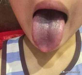 神了！舌苔的颜色揭露了你的身体状况，快看看你是什么颜色