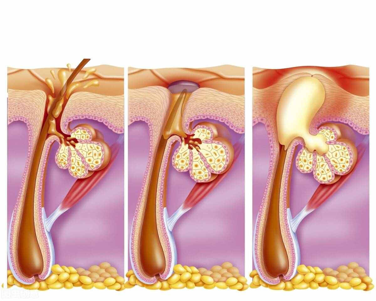 皮肤“闭口”是什么情况？用什么药可以清除？医生给你仔细剖析