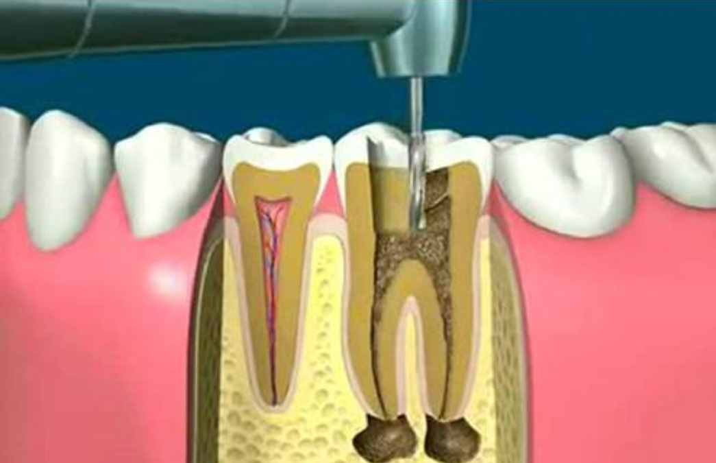 牙周医生王刃：牙医说要做“根管治疗”，那么什么是根管治疗呢？