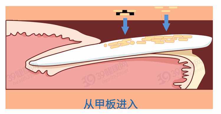 得了灰指甲，反复发作难根治？一次性介绍7种药，总有一款适合你