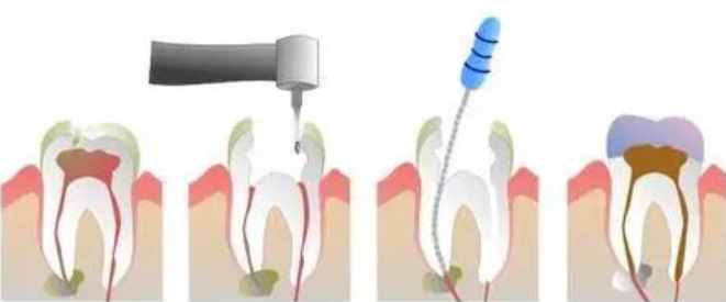 牙周医生王刃：牙医说要做“根管治疗”，那么什么是根管治疗呢？