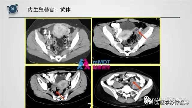 子宫附件影像解剖