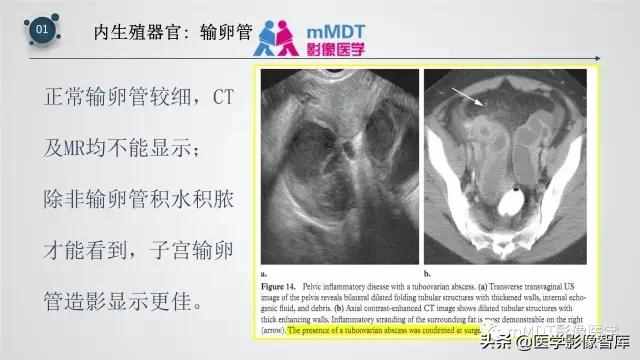 子宫附件影像解剖