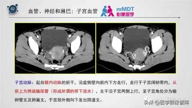 子宫附件影像解剖