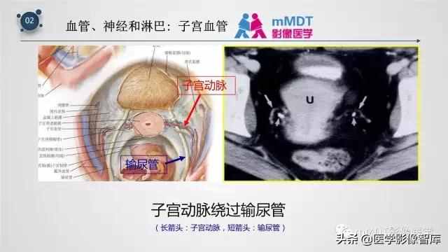 子宫附件影像解剖