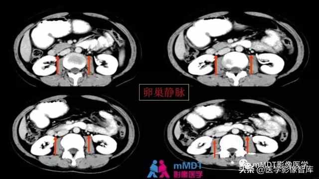 子宫附件影像解剖