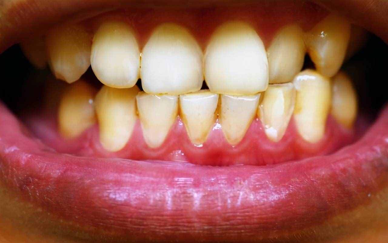 “牙结石”可以用手抠掉吗？教你一招，牙缝里的脏东西或能轻松掉