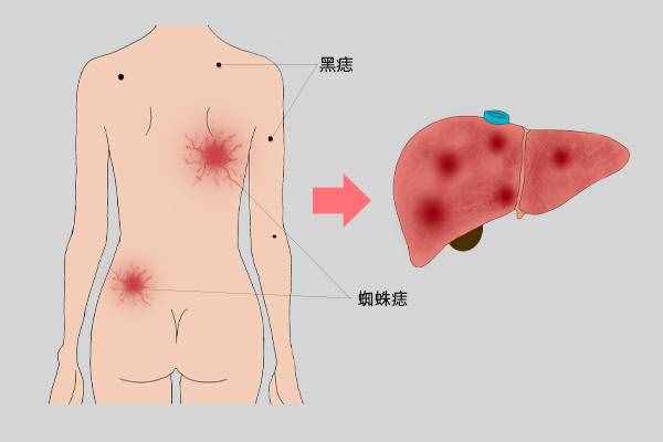 皮肤上突然出现了很多小红点，是怎么回事？和肝病有关系吗？