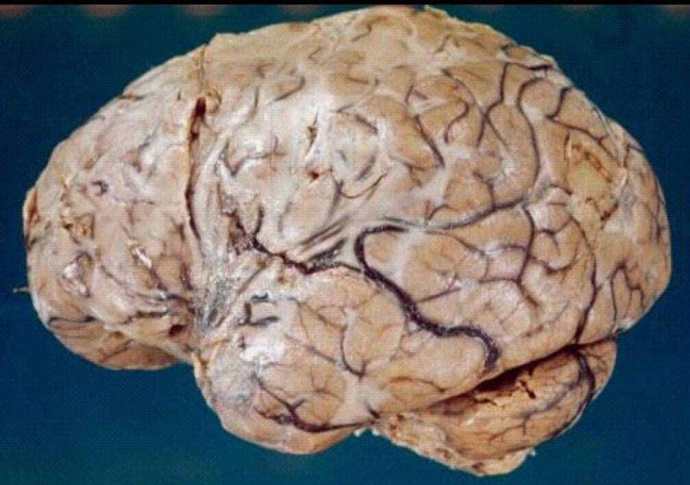 干燥综合征即舍格伦综合征，以神经损伤为主，如周围神经病变等