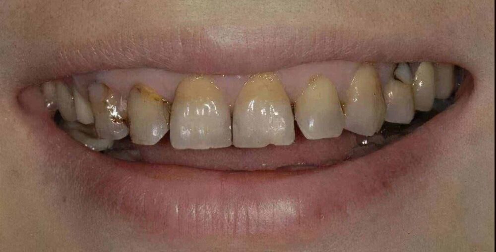 牙齿为什么越来越黄？常见的三种美白方式了解一下