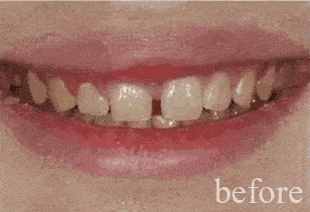 牙齿为什么越来越黄？常见的三种美白方式了解一下