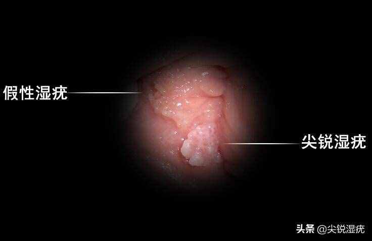 女性真假尖锐湿疣如何分辨