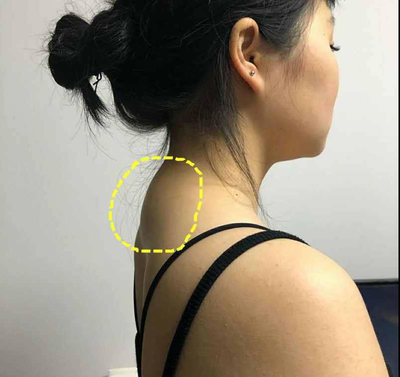 科学锻炼消除“富贵包”