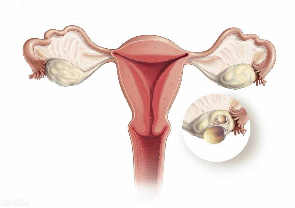 卵巢囊肿，可分生理性和病理性两种，诱发因素和环境及饮食有关